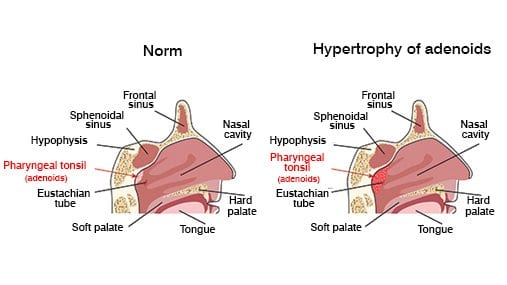 Snoring in children | Dr.Rao's ENT