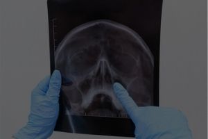 Rhinology & Anterior Skull Base Surgeries