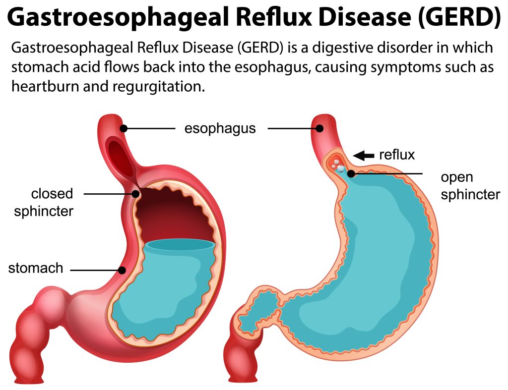 The Relationship Between Acid Reflux and Throat Dr Rao's